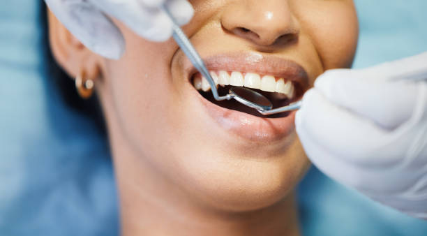 Best Emergency Wisdom Teeth Removal in Waynesville, OH